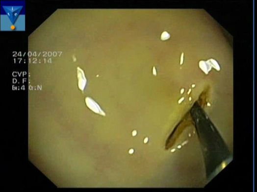Fig.1 Incisione della parete gastrica chirurgia transgastric